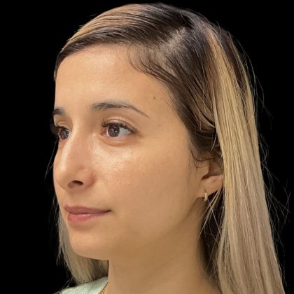 Liquid Rhinoplasty Before & After Patient #11930
