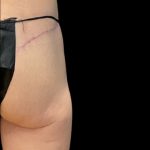 Alloclae Before & After Patient #11888