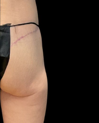 Alloclae Before & After Patient #11888