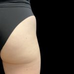 Alloclae Before & After Patient #11885