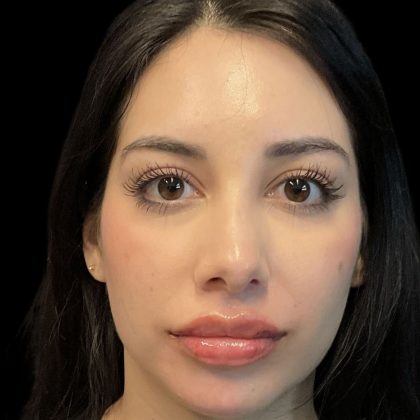 Chin Filler Before & After Patient #11851