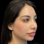 Chin Filler Before & After Patient #11851