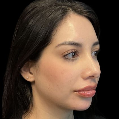 Chin Filler Before & After Patient #11851