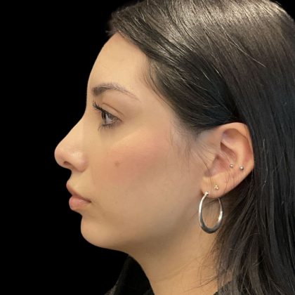 Chin Filler Before & After Patient #11851