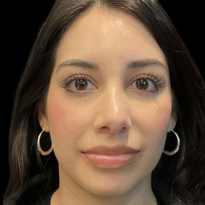 Chin Filler Before & After Patient #11851