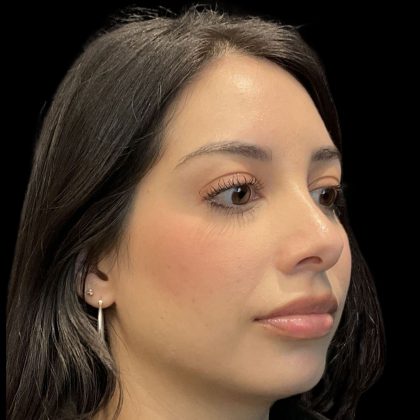 Chin Filler Before & After Patient #11851