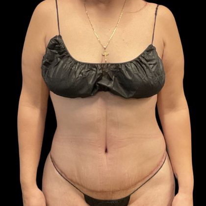 Tummy Tuck Before & After Patient #11864