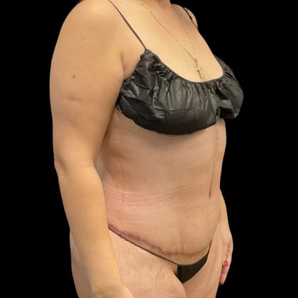 Tummy Tuck Before & After Patient #11864