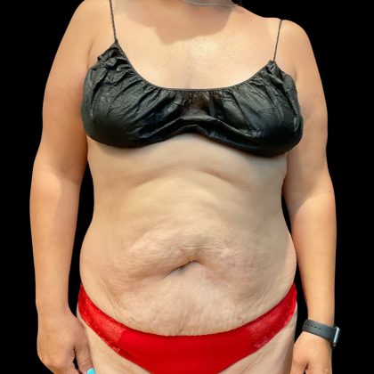 Tummy Tuck Before & After Patient #11864