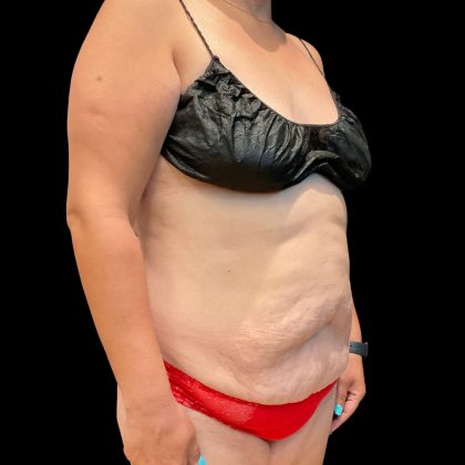 Tummy Tuck Before & After Patient #11864