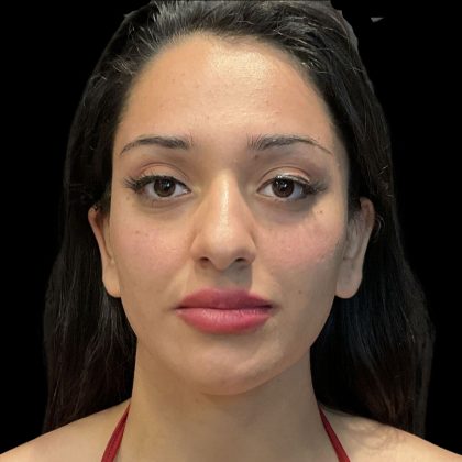 Instalift Before & After Patient #11923