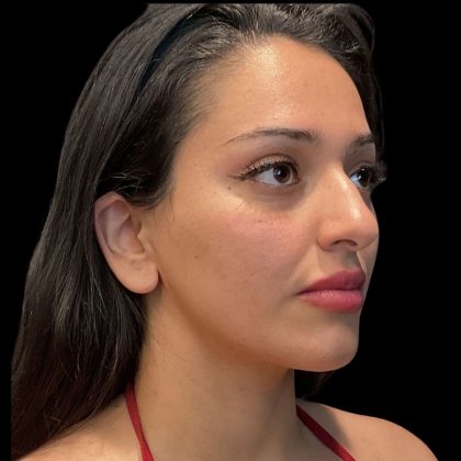 Instalift Before & After Patient #11923