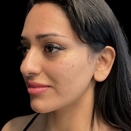 Instalift Before & After Patient #11923
