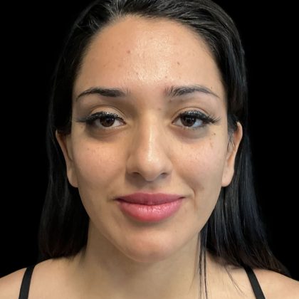 Instalift Before & After Patient #11923