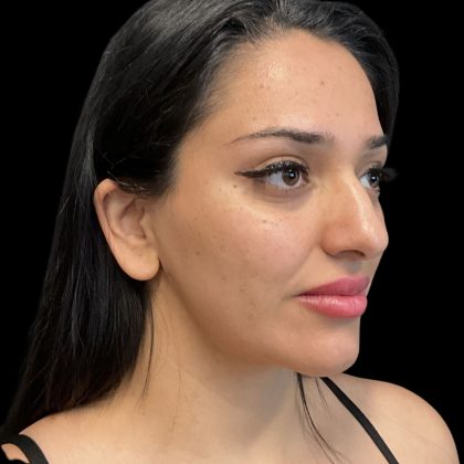 Instalift Before & After Patient #11923
