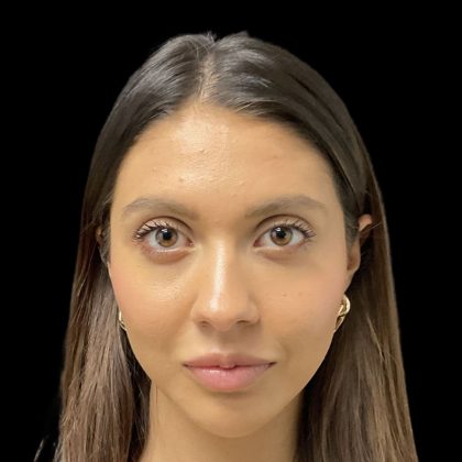 Cheek Filler Before & After Patient #11914