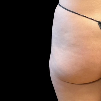 Alloclae Before & After Patient #11882