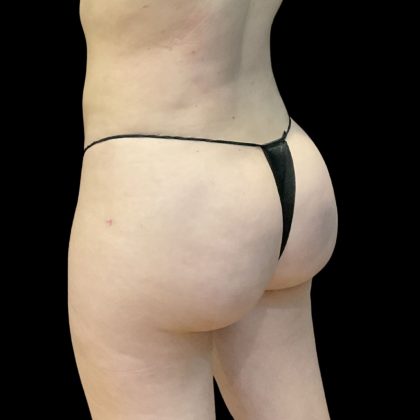 Brazilian Butt Lift Before & After Patient #11835