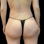 Brazilian Butt Lift Before & After Patient #11835