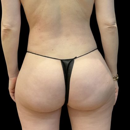 Brazilian Butt Lift Before & After Patient #11835