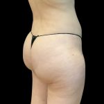 Brazilian Butt Lift Before & After Patient #11835