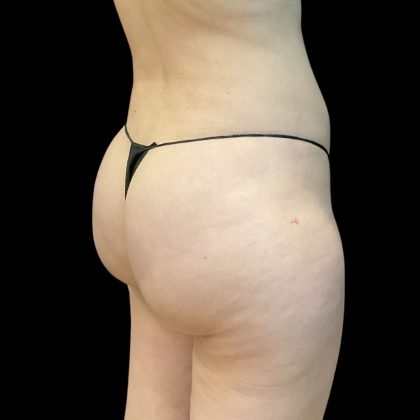Brazilian Butt Lift Before & After Patient #11835
