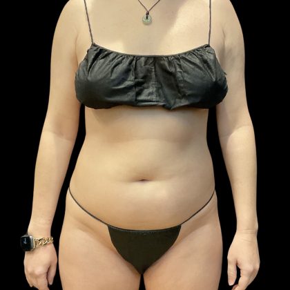 Brazilian Butt Lift Before & After Patient #11835