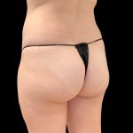 Brazilian Butt Lift Before & After Patient #11835