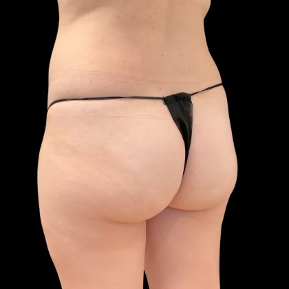 Brazilian Butt Lift Before & After Patient #11835
