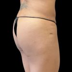 Alloclae Before & After Patient #11871