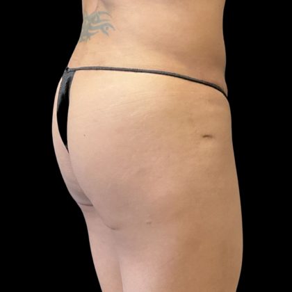 Alloclae Before & After Patient #11871