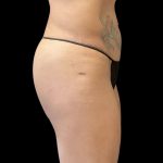 Alloclae Before & After Patient #11871