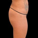 Alloclae Before & After Patient #11871