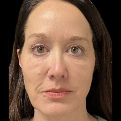 AVAVA Laser Before & After Patient #11844