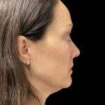 AVAVA Laser Before & After Patient #11844