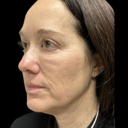 AVAVA Laser Before & After Patient #11844