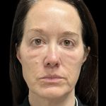 AVAVA Laser Before & After Patient #11844