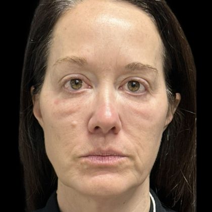 AVAVA Laser Before & After Patient #11844