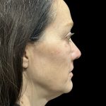 AVAVA Laser Before & After Patient #11844