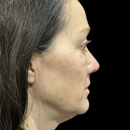 AVAVA Laser Before & After Patient #11844