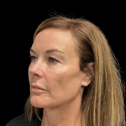 AVAVA Laser Before & After Patient #11828