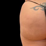 Alloclae Before & After Patient #11891