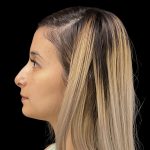 Liquid Rhinoplasty Before & After Patient #11930