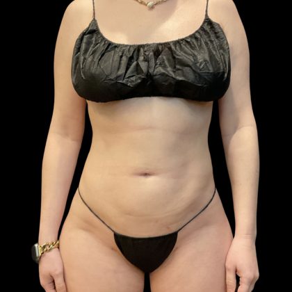 Brazilian Butt Lift Before & After Patient #11835