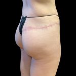Auto Buttock Augmentation Before & After Patient #11958