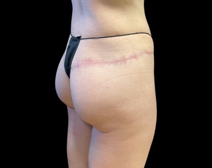 Auto Buttock Augmentation Before & After Patient #11958
