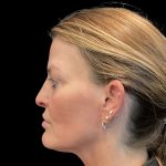 Sculptra Before & After Patient #11963