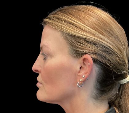 Sculptra Before & After Patient #11963