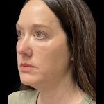 AVAVA Laser Before & After Patient #11844