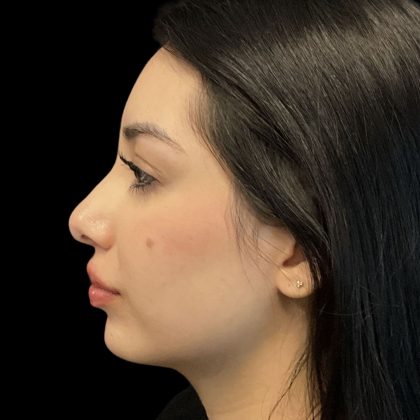 Chin Filler Before & After Patient #11851